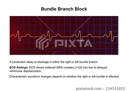ECG in bundle branch block, 3D illustration 134531855