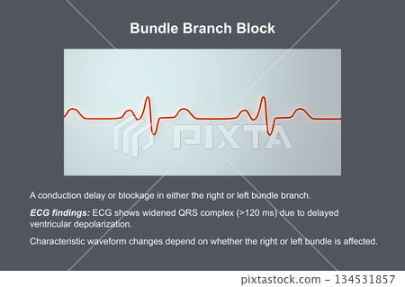 ECG in bundle branch block, 3D illustration 134531857