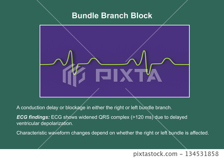 ECG in bundle branch block, 3D illustration 134531858