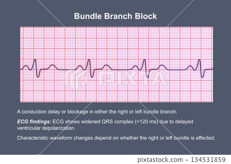 ECG in bundle branch block, 3D illustration ECG in bundle branch block, 3D illustration 134531859