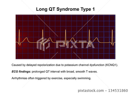 ECG in long QT syndrome type 1, 3D illustration, annotated ECG in long QT syndrome type 1, 3D illustration, annotated 134531860