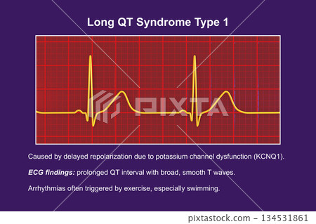 ECG in long QT syndrome type 1, 3D illustration, annotated ECG in long QT syndrome type 1, 3D illustration, annotated 134531861