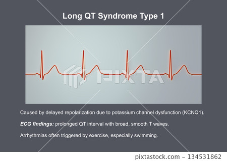 ECG in long QT syndrome type 1, 3D illustration, annotated ECG in long QT syndrome type 1, 3D illustration, annotated 134531862
