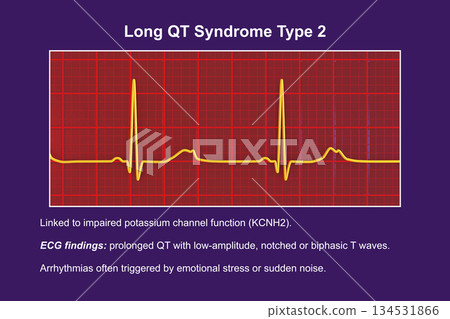 ECG in long QT syndrome type 2, 3D illustration, annotated ECG in long QT syndrome type 2, 3D illustration, annotated 134531866