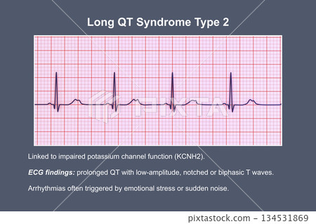 ECG in long QT syndrome type 2, 3D illustration, annotated ECG in long QT syndrome type 2, 3D illustration, annotated 134531869