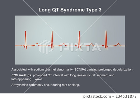 ECG in long QT syndrome type 3, 3D illustration, annotated ECG in long QT syndrome type 3, 3D illustration, annotated 134531872