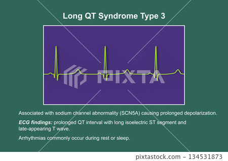 ECG in long QT syndrome type 3, 3D illustration, annotated ECG in long QT syndrome type 3, 3D illustration, annotated 134531873