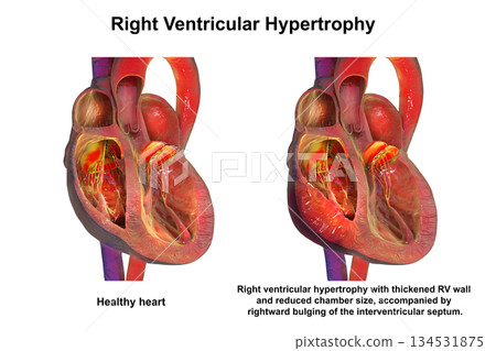 Right ventricular hypertrophy, 3D illustration. Right ventricular hypertrophy, 3D illustration. 134531875