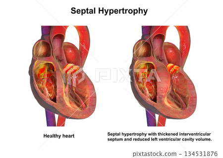 Septal hypertrophy, 3D illustration Septal hypertrophy, 3D illustration 134531876
