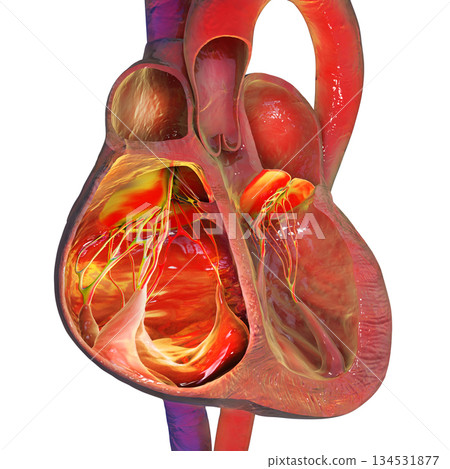 Right ventricular dilation, 3D illustration Right ventricular dilation, 3D illustration 134531877