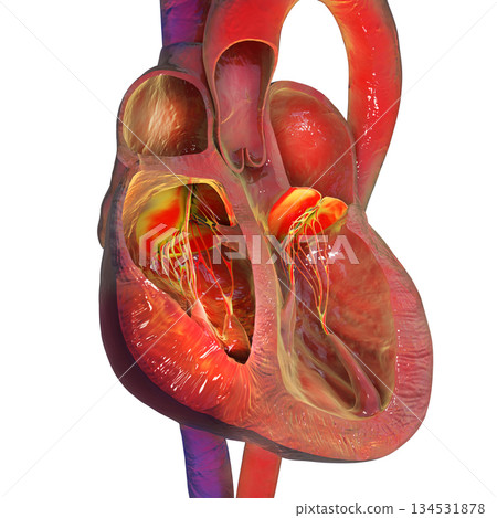 Right ventricular hypertrophy, 3D illustration. Right ventricular hypertrophy, 3D illustration. 134531878