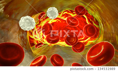 Saddle pulmonary embolism, 3D illustration, inside pulmonary trunk bifurcation Saddle pulmonary embolism, 3D illustration, inside pulmonary trunk bifurcation 134531989