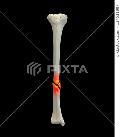 Tibia shaft fracture, 3D illustration. Shows a break in the tibial shaft, commonly caused by trauma. Clinically important for orthopedic assessment, surgical fixation, and fracture classification. 134531997