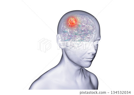 Brain tumor, 3D illustration 134532034