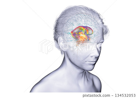 A brain tumor causing hydrocephalus, 3D illustration A brain tumor causing hydrocephalus, 3D illustration 134532053