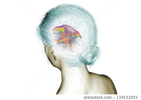 A brain tumor causing hydrocephalus, 3D illustration 134532055