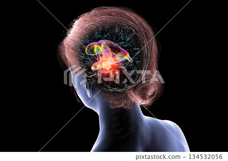 A brain tumor causing hydrocephalus, 3D illustration 134532056
