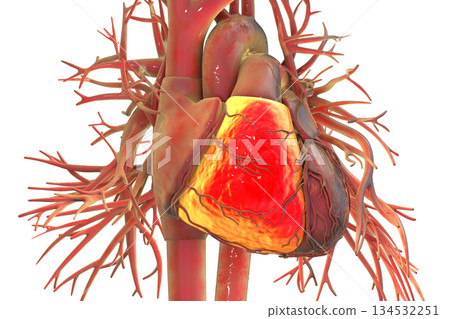 Human heart with right ventricle highlighted in red, 3D illustration. Human heart with right ventricle highlighted in red, 3D illustration. 134532251