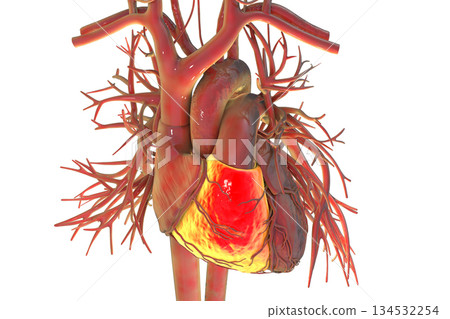 Human heart with right ventricle highlighted in red, 3D illustration. Human heart with right ventricle highlighted in red, 3D illustration. 134532254