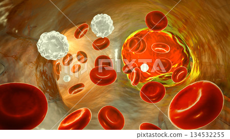 Left pulmonary embolism, 3D illustration, inside pulmonary trunk Left pulmonary embolism, 3D illustration, inside pulmonary trunk 134532255