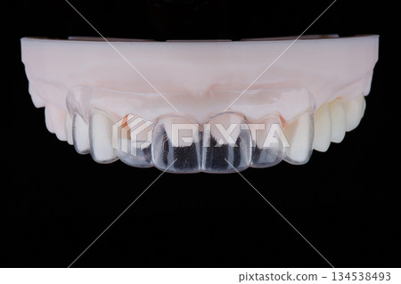 3D printed transparent dental template for gum correction fixed on model on black background. 3D printed transparent dental template for gum correction fixed on model on black background. 134538493