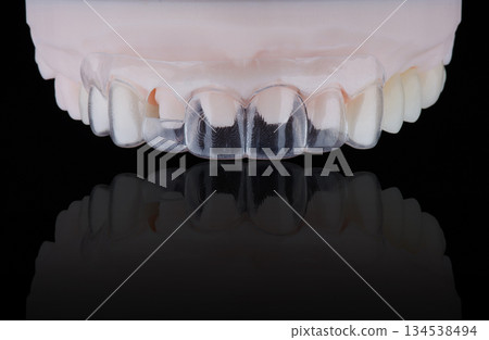 3D printed transparent dental template for gum correction fixed on model on black background. 3D printed transparent dental template for gum correction fixed on model on black background. 134538494