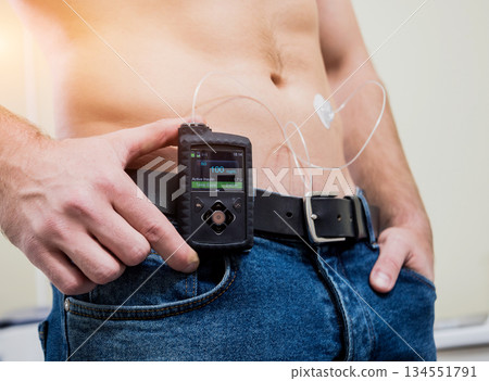 Diabetic man with an insulin pump connected in his abdomen  134551791