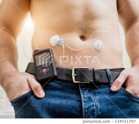 Diabetic man with an insulin pump connected in his abdomen  134551797