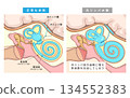 The normal state of the middle and inner ear and the state of the endolymphatic duct when endolymphatic hydrops or Meniere's disease occurs 134552383