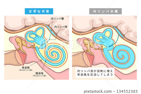 The normal state of the middle and inner ear and the state of the endolymphatic duct when endolymphatic hydrops or Meniere's disease occurs The normal state of the middle and inner ear and the state of the endolymphatic duct when endolymphatic hydrops or Meniere's disease occurs 134552383