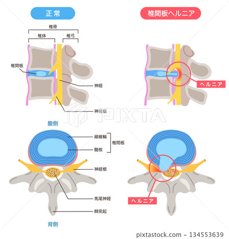 Lumbar disc herniation, structure of the intervertebral disc, lower back pain Lumbar disc herniation, structure of the intervertebral disc, lower back pain 134553639