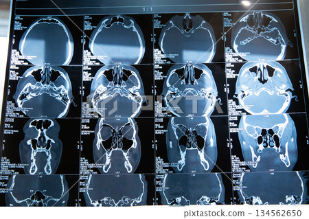 Comprehensive CT Scan Views of Human Skull Anatomy 134562650