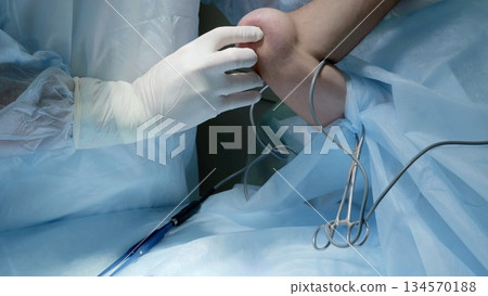 Russia Tomsk 05.07.2025: Nurse applying tourniquet on lower leg prior to operation, gloved hands adjusting strap and checking pressure, nearby monitoring cables and sterile drapes create 134570188