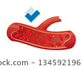 Type of cholesterol in human blood vessels. Normal artery for explanation disease. High-Density Lipoprotein HDL. Vector illustration 134592196