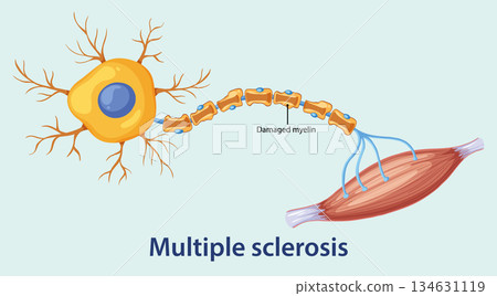 Damaged Myelin Sheath in Multiple Sclerosis Illustration 134631119