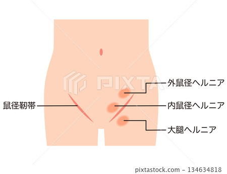 腹股溝疝氣的類型 髖關節疝 腹股溝疝氣的類型 髖關節疝 134634818