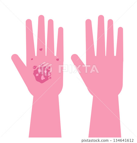 Hands with Psoriasis before and after treatment. Vector illustration 134641612