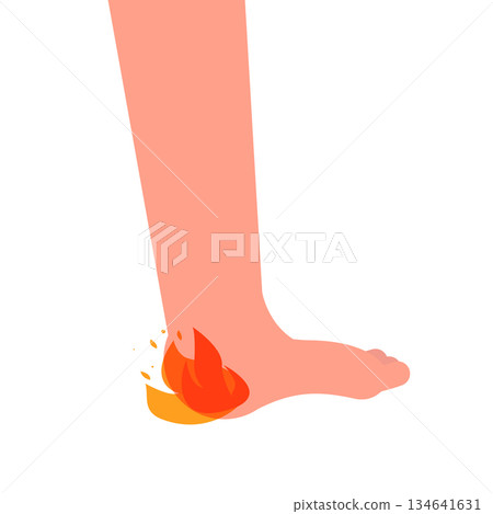 Heel spur, aches, hot burn sensation. Vector illustrations. 134641631