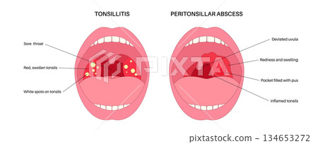 Peritonsillar abscess and tonsillitis 134653272