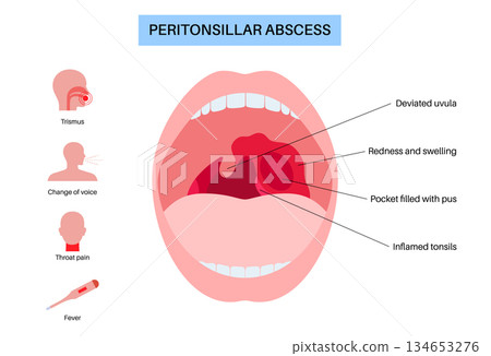Peritonsillar abscess poster 134653276