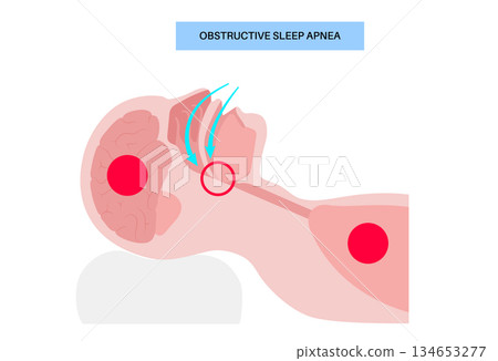 Obstructive sleep apnea 134653277