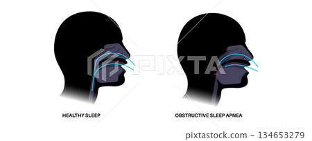 Obstructive sleep apnea 134653279