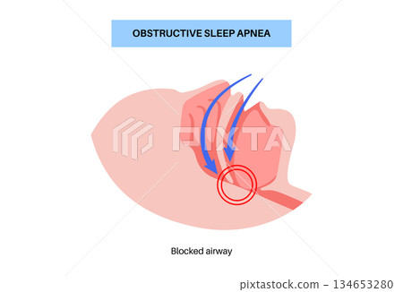Obstructive sleep apnea Obstructive sleep apnea 134653280