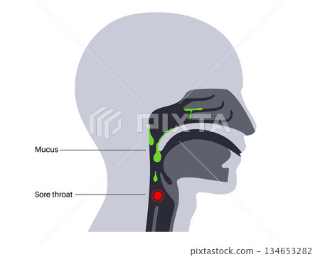 Postnasal drip poster 134653282
