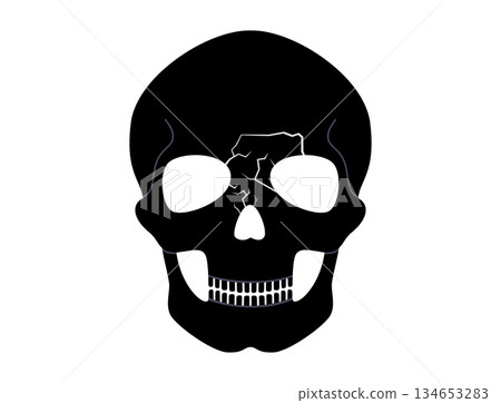 Nasal fracture poster 134653283