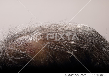 Head cut injury, stitches removed on the seventh day 134663832