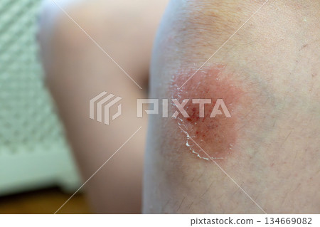Skin rash on caucasian boy with dry texture and redness Skin rash on caucasian boy with dry texture and redness 134669082