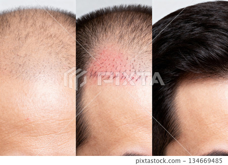 Hair restoration transformation: before, during, and after hair transplant journey for confidence and renewal 134669485