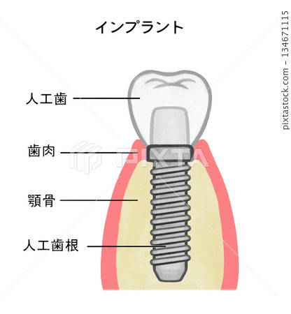 植入體結構示意圖 - 1 134671115