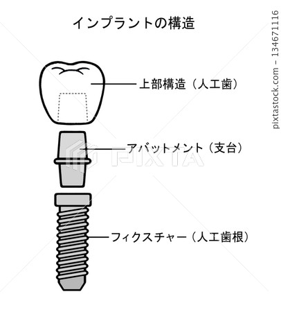 Illustration of implant structure - 2 134671116